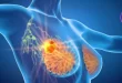 مراحل پیشرفت سرطان سینه و درمان آن