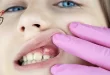 علت آبسه دندان و روشهای درمان خانگی آن